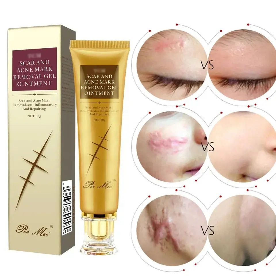 Fast anti acne cream anti spots treatment scar mark removal cream stretch marks repair acne treatment