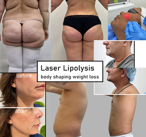 980nm nm1470nm không xâm lấn vaser lipolysis phẫu thuật hút mỡ máy endo Laser mặt nâng - Product Image 6