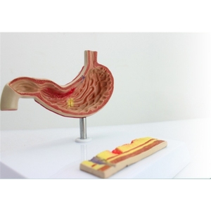 Factory PVC Anatomical Model for Gastric Pathology Perforation and Ulcer Section Enhanced Communication Reduction <strong>Explanation</strong> - Product Image 6