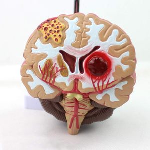 KyrenMed İnsan beyin patolojik Model malforme beyin hastalıklı yapı beyin epilepsi inme serebral vasküler hastalık modeli - Product Image 2