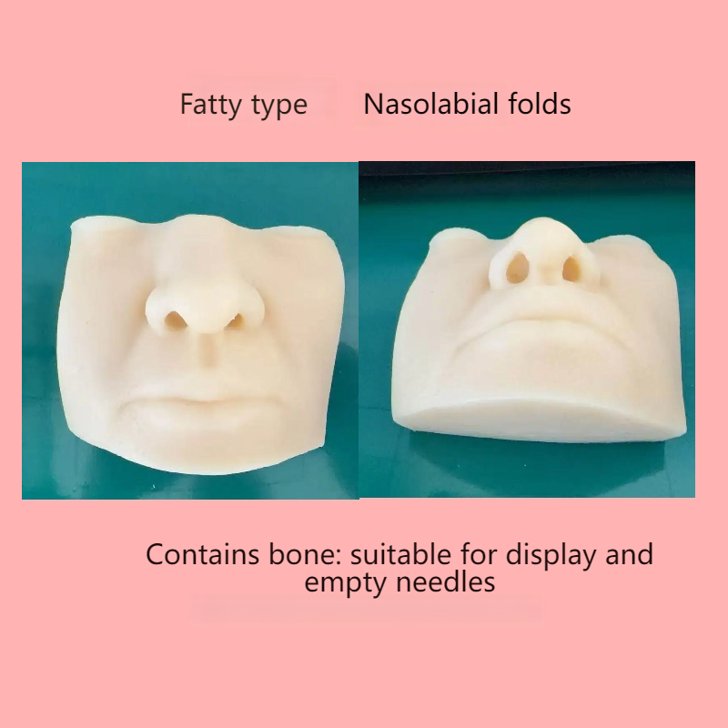Plis nasogéniens de type Blue Fat