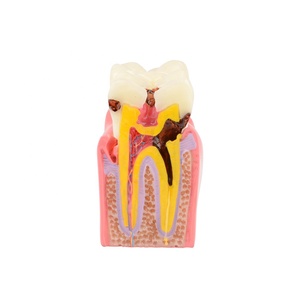 Dental Teeth Model Dental Caries Tooth Model for Patient Education and <strong>Explanation</strong> - Product Image 1