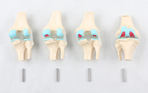 Insan diz eklemi anatomik Model dört aşamalı patolojik diz eklem modeli kemik eklem erozyon gösteri tıbbi modeli - Product Image 4