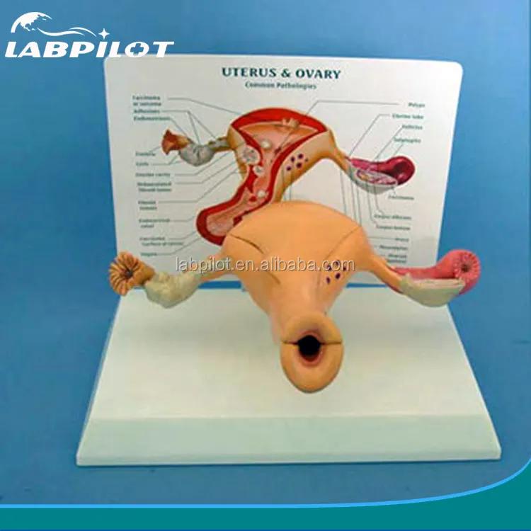 Human uterus and ovary model,The uterus disease model