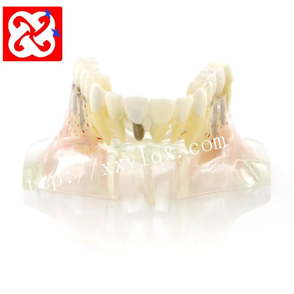 Metade superior dental modelo de implante com sinusite para demostration