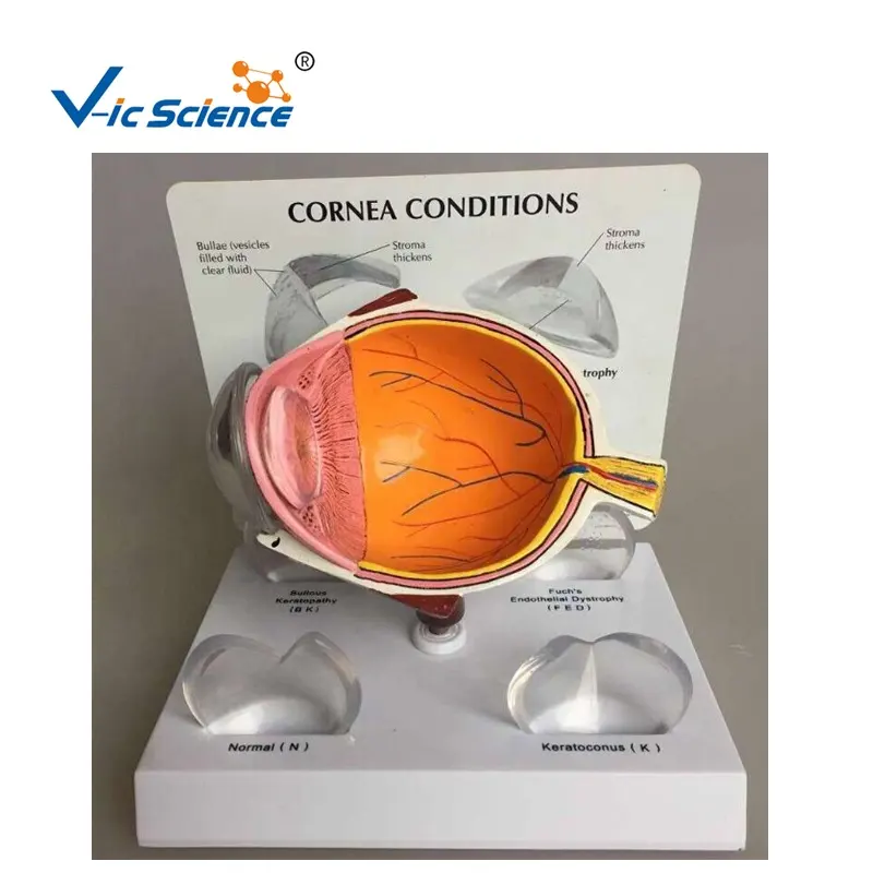 Modelo Médico de ojos patológicos de Cornea