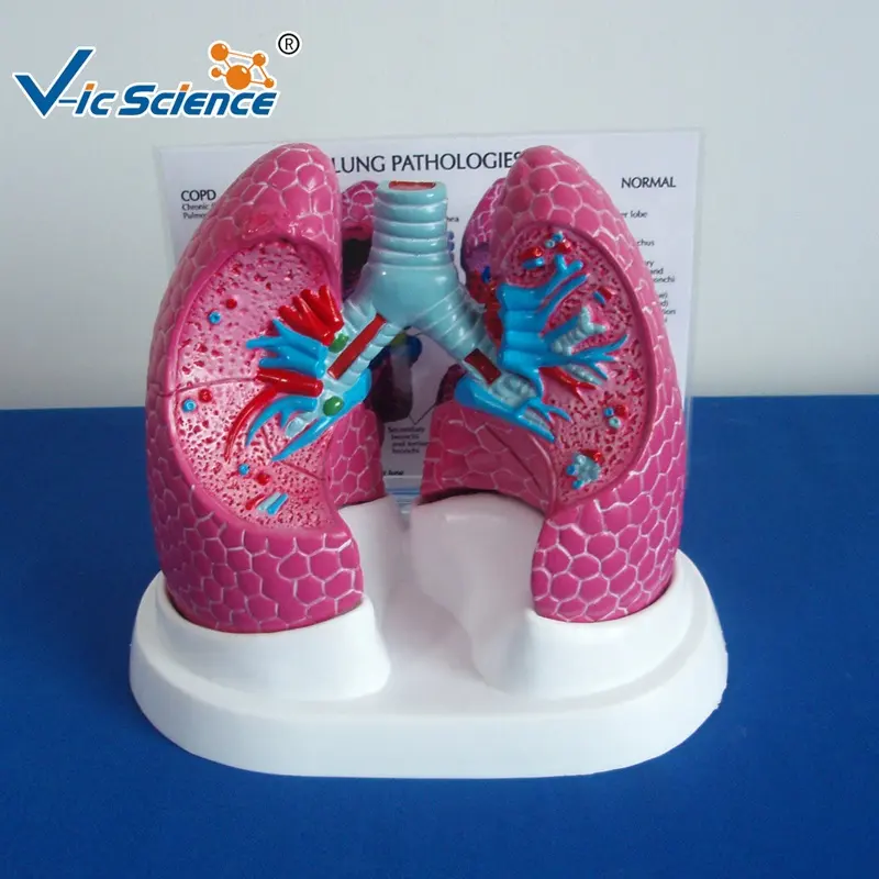 Medical Bronchopulmonary Disease Pathological And lung Anatomical Model