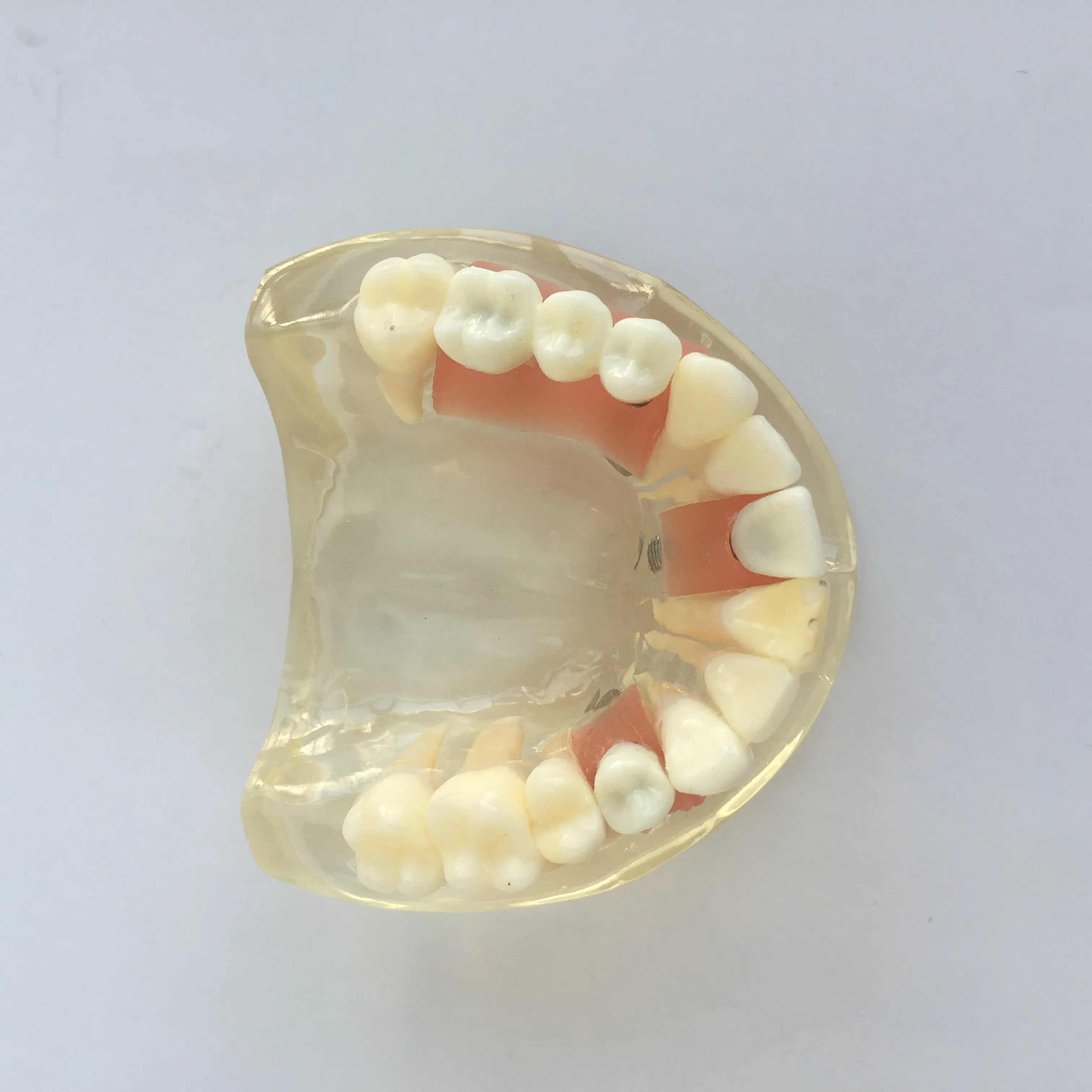 Modèle d'implant dentaire de la partie supérieure de modèle dentaire montre butée gomme tendre et pont