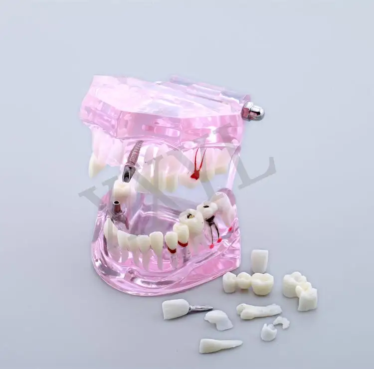 İmplant restorasyon patolojik diş modeli gösteri için