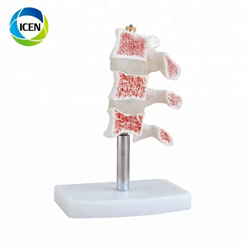 In-103 coluna vertebraz humana lombar com discos intervertebrais modelo cortado osteoporose modelo para ensino