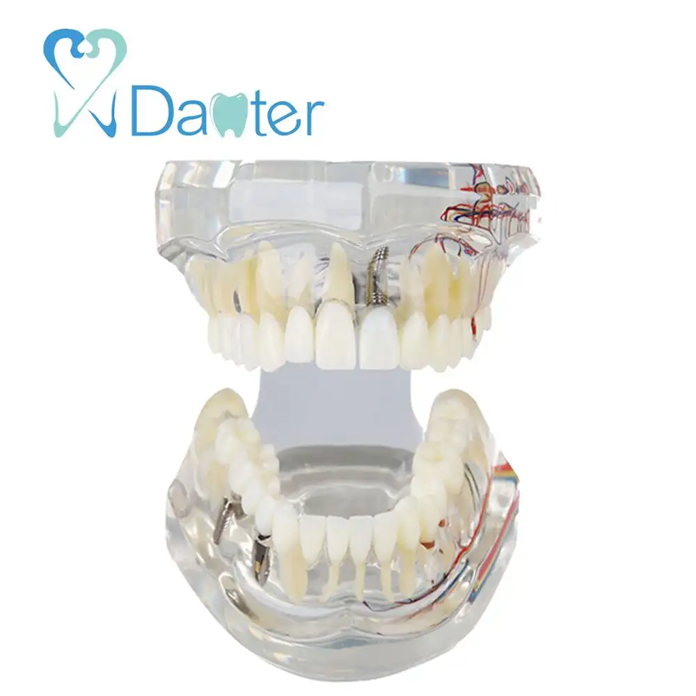 A200-2 tudo em um modelo de boêmio dentário com nervoso e removível pontas coroa de dentes