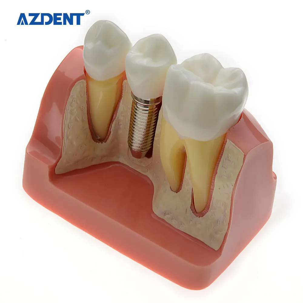 Modelo de estudo dental, dentes dentários de alta qualidade, modelo de implante dentário usado para adultos