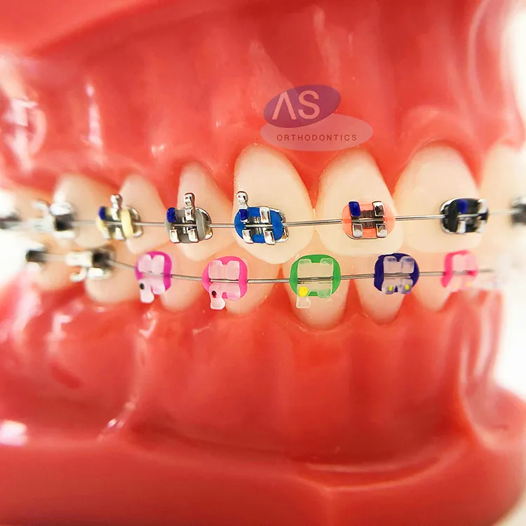 ทันตกรรมทันตกรรมจัดฟัน Ligature ผูกยาง