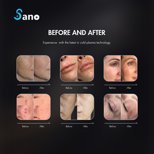 Kalte Plasma maschine Heiß Kalt Plasma Gesichts lifting Therapie Gesichts straffung Haut Sommersprossen Entfernung - Product Image 4