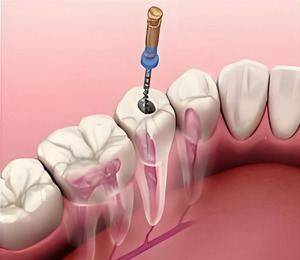 Fichiers rotatifs endodontiques en Niti dentaire, fichiers rotatifs universels en Niti dentaire, fichiers rotatifs endodontiques dentaires - Product Image 6