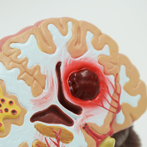 Medizintechnik menschliches Organ pathologisches Hirnanatomie-Modell zeigt die pathologische Hirnstruktur von Schlaganfall - Product Image 2
