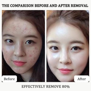 Gạo tùy chỉnh tẩy tế bào chết Ampoule Set-Nhẹ nhàng vỏ lỗ chân lông giảm thiểu hydrat hóa sâu đen trắng gạo cho sáng khuôn mặt phát sáng - Product Image 6