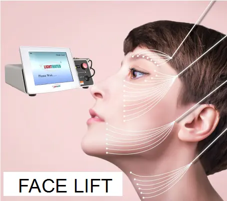 Endolaser Estiramiento facial Procedimiento de recuperación rápida Endo DE LA PIEL 1470nm 17 vatios Láser dual 980nm Máquina de terapia con láser de diodo