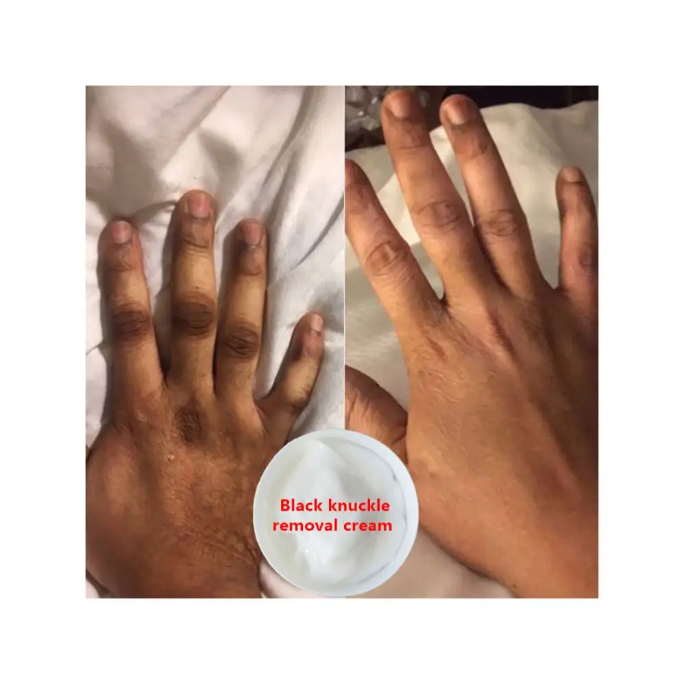 Mỹ phẩm nửa thành phẩm đốm đen khuỷu tay sắc tố correctors mạnh mẽ knuckles Remover tối knuckles Remover