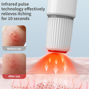 Điện thoại Côn trùng chống ngứa bút cầm tay điện muỗi Bug cắn healer tinh khiết vật lý cứu trợ ngứa côn trùng cắn đánh dấu đi - Product Image 2