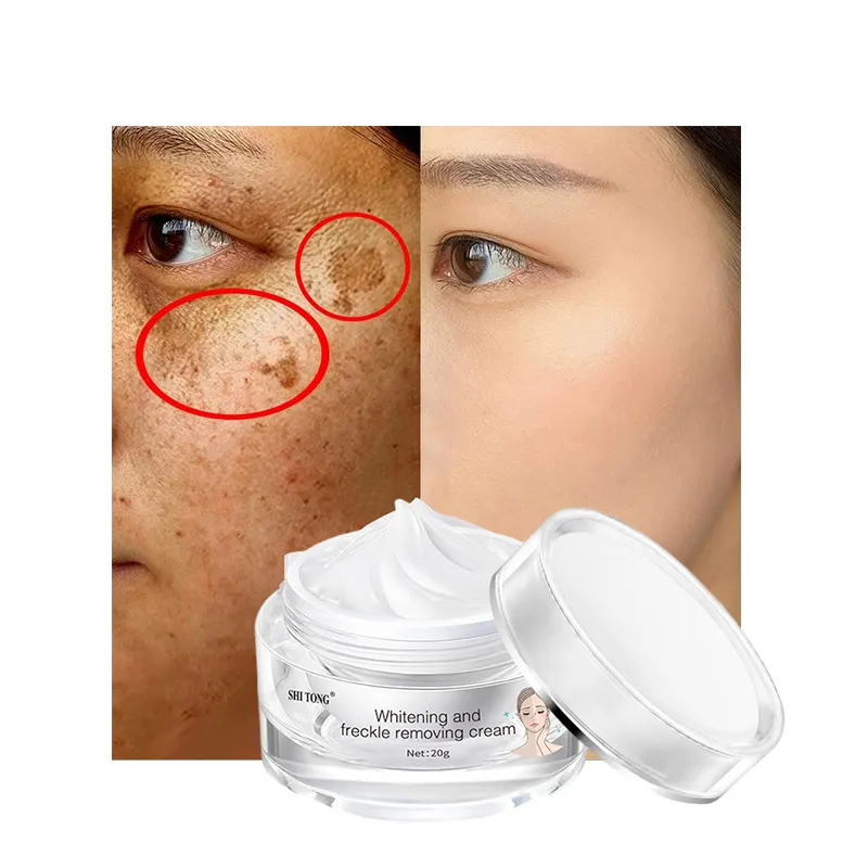 Crema blanqueadora facial, crema para eliminar pecas y manchas oscuras