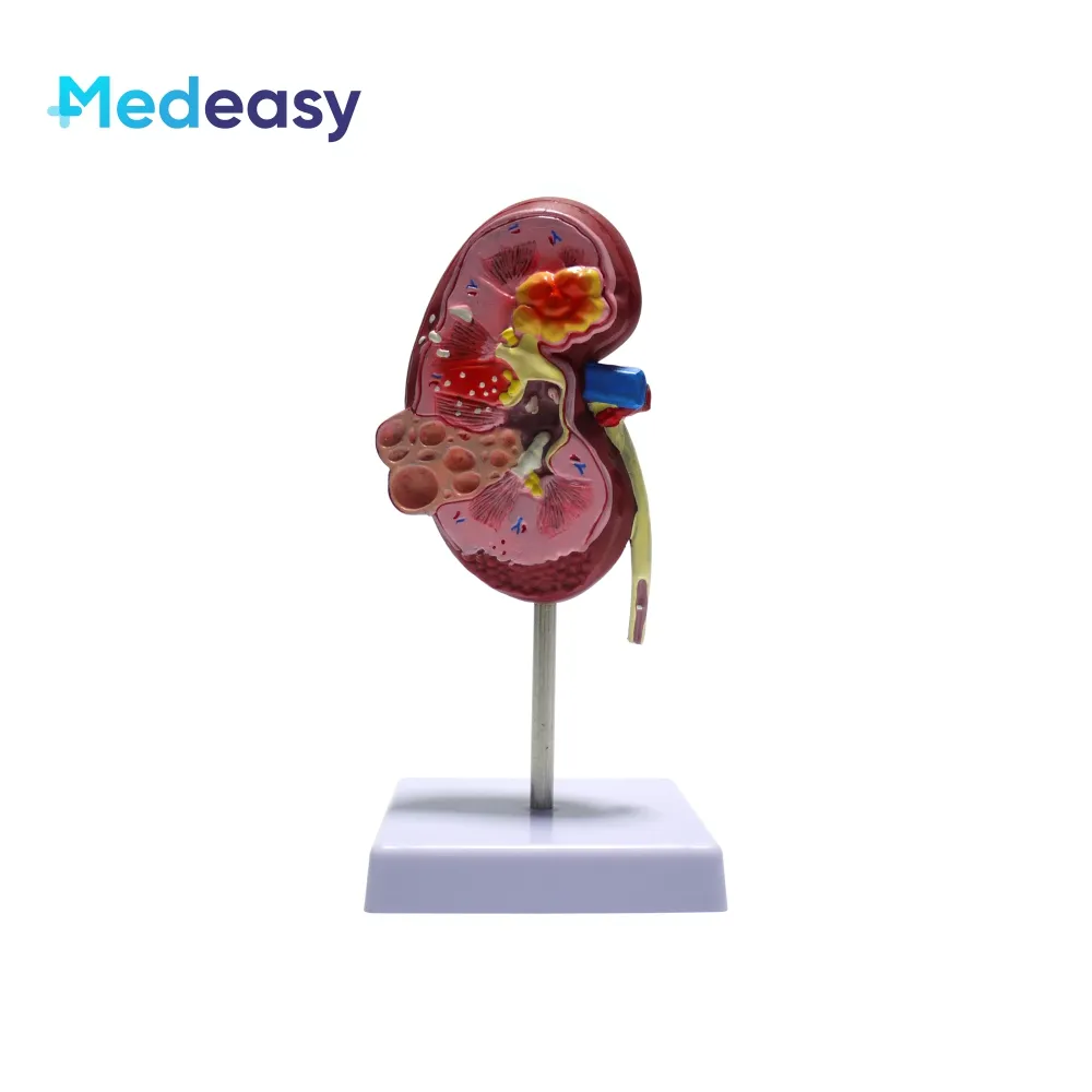 Human body normal and pathological kidney model medical teaching aids