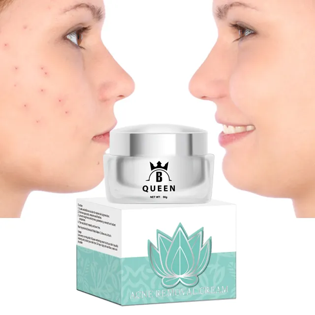 Worden Koningin Acne En Donkere Vlek Remover Gezicht En Body Cream Geavanceerde Behandeling Voor Oude En Nieuwe Littekens Acne Melasma crème