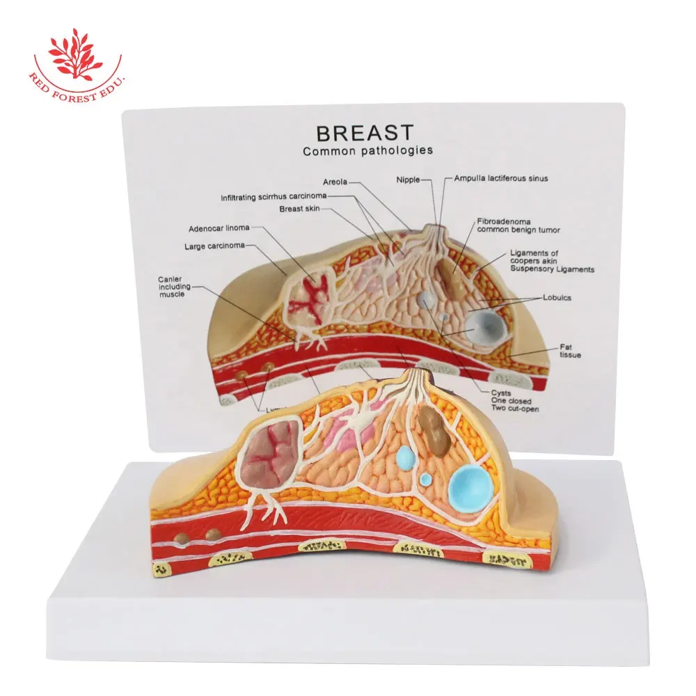 Modelo de cáncer de pecho femenino para enseñanza, ayuda escolar para médicos ginecológicos, sección transversal de pecho, modelo anatomico de pecho de PVC