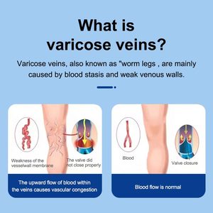 Dermfree giãn tĩnh mạch Kem-Cứu trợ tự nhiên cho chân sưng & nhện 60g - Product Image 4