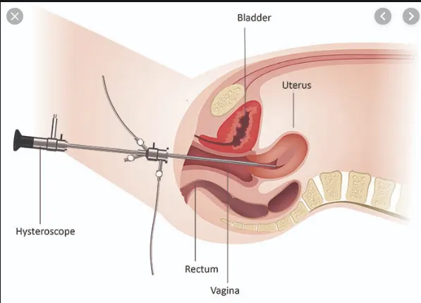 Cámara endoscópica quirúrgica portátil para la vagina