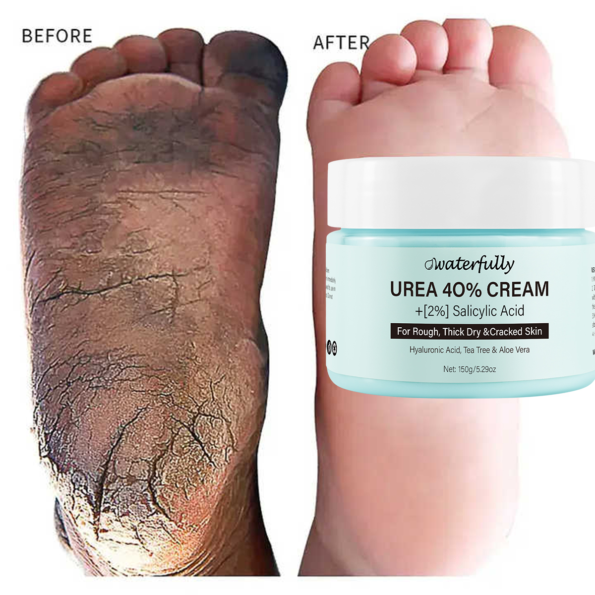 Urea + Ácido Salicílico