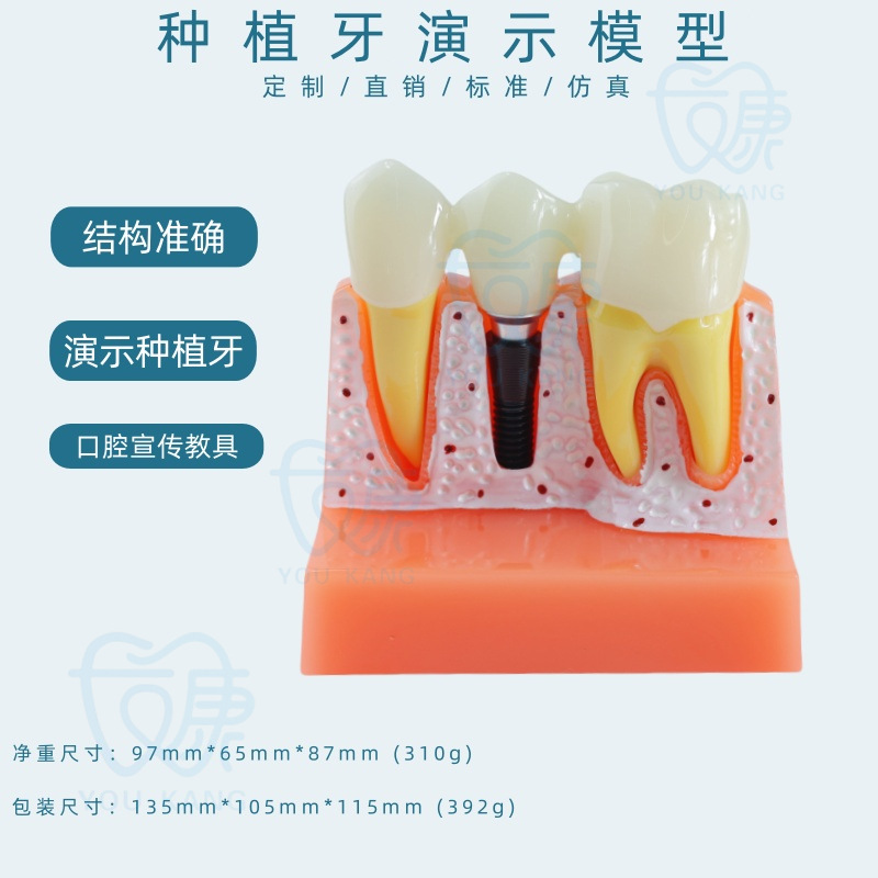 Implant dentaire B, clou blanc et noir.
