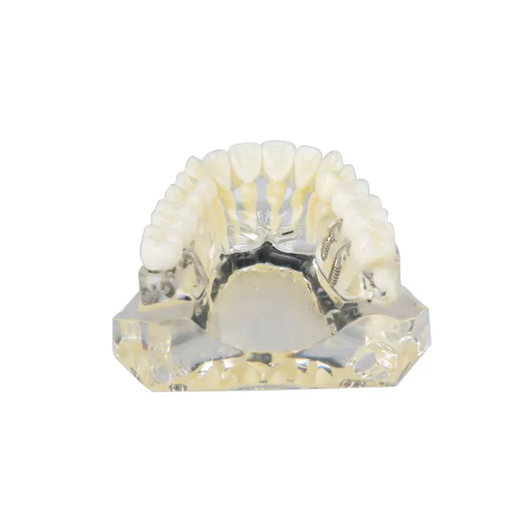 Modelo de implante maxilar transparente, para estudiante de universidad dental