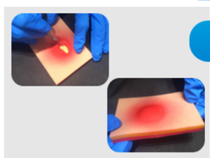 Piel realista de simulación médica de PVC para entrenamiento de incisión y drenaje de abscesos Entrenamiento de simulación médica para abscesos - Product Image 3