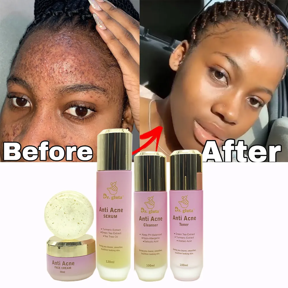 Private Label miglior Kit viso per rimuovere i brufoli dell'acne e le macchie scure prodotti per la cura della pelle per il viso Anti Acne