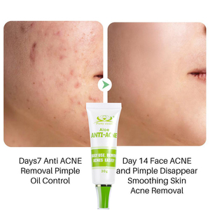 Herbal Essence crème d'élimination des cicatrices d'acné visage Dack crème d'élimination des taches extrait de plantes végétaliennes crème contre l'acné pour la peau noire - Product Image 2