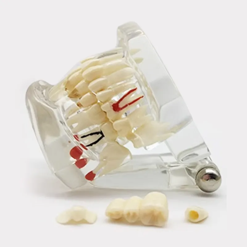 Science médicale étude restauration orthodontique modèle de dents dentaires pathologique implant modèle de dents