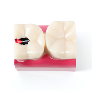 Azdent Dental Teaching Model 6Times Tooth Decay Two Side Anatomical Contrast for Patient Education and <strong>Explanation</strong> - Product Image 3