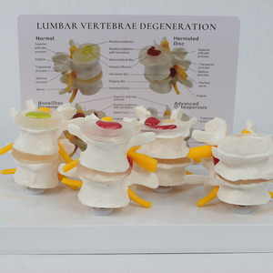 SCIEDU Teaching Resource Medical <strong>Human</strong> Skeleton Model Comparative Model of 4-stage Pathological Lumbar Spine with <strong>Back</strong> Card - Product Image 4
