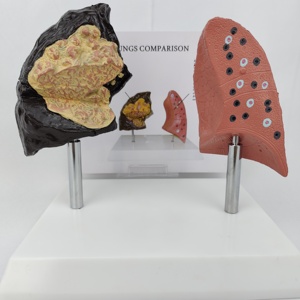 Comparison Model Between Normal Human Lungs Smoking/Drug-Using Lungs Medical Science Product Comprehensive <strong>Explanation</strong> Basis - Product Image 5