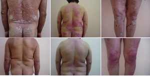 La photothérapie UVB la plus efficace pour l'arthrite psoriasique la photothérapie UV du corps entier unit les KN-4001B - Product Image 4