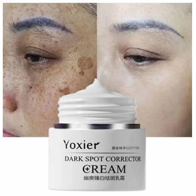 Fuerte Eliminación El melasma Crema para blanquear peca de speckle quemaduras puntos pigmento melanina cicatriz eliminación blanquear peca cara