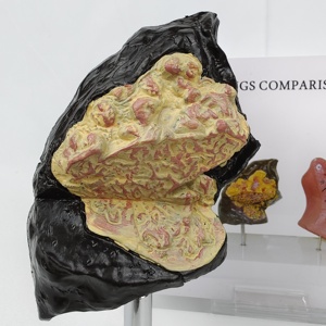 Comparison Model Between Normal Human Lungs Smoking/Drug-Using Lungs Medical Science Product Comprehensive <strong>Explanation</strong> Basis - Product Image 2