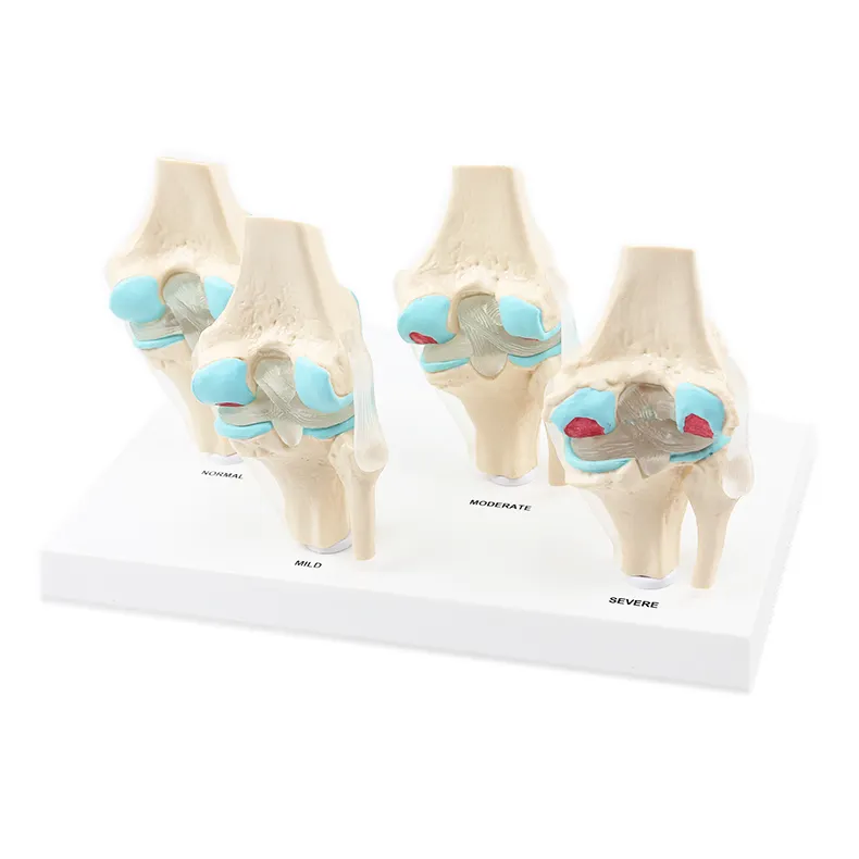 Modelo anatómico de articulación de rodilla humana modelo patológico de cuatro etapas articulación de rodilla modelo de erosión ósea modelo médico