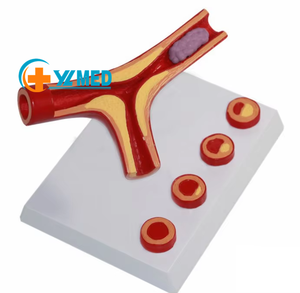 <strong>Human</strong> Blood Vessel Magnification Model Thrombus Model Blood Vessel Model - Product Image 1