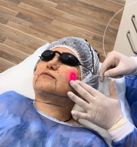 أحدث شفط الدهون بالليزر ديود 980 نانومتر 1470 نانومتر ليزر تحلل الدهون لمكافحة السيلوليت آلة رفع الوجه إندو ليزر رفع - Product Image 5