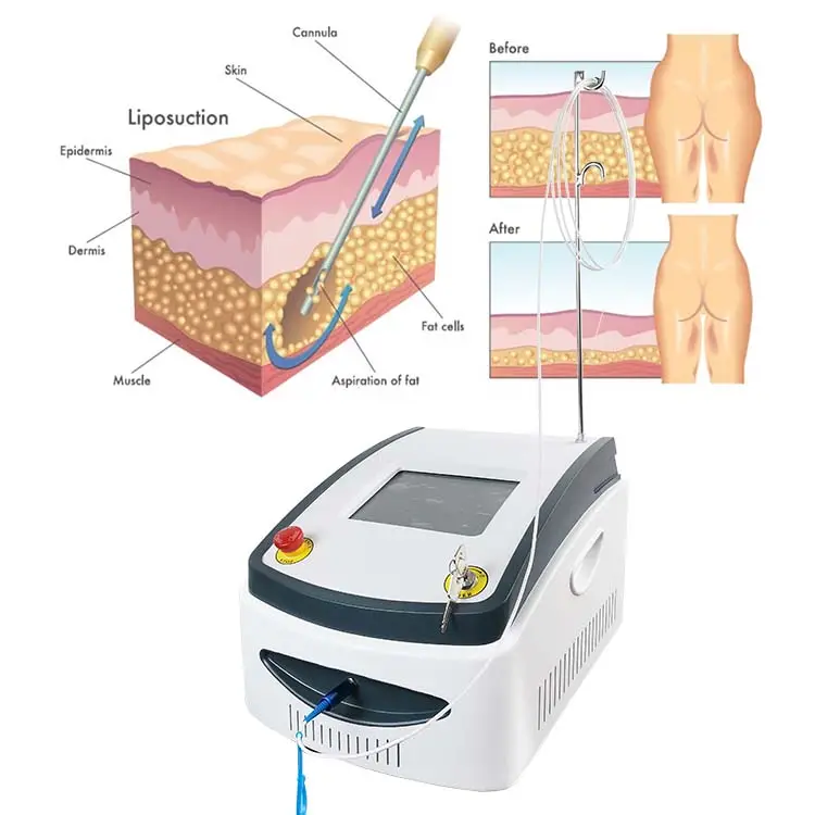 Professionale diodo laser 980 nm portatile chirurgico laser liposuzione macchina di perdita di peso del corpo micro fibra di vaser liposuzione