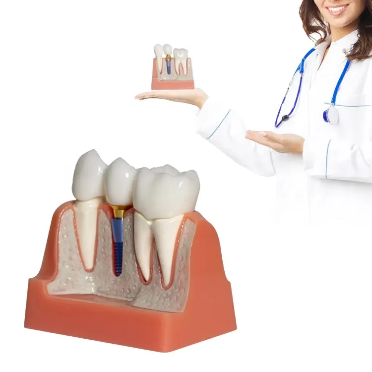 Offre Spéciale Patient Modèle D'éducation Dentaire Implant Modèles forTeaching démonstration