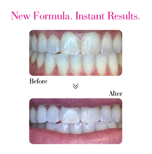GlorySmile yeni formül 35% <span class=keywords><strong>PAP</strong></span> diş beyazlatma ağız yıkama özel etiket Oral temizlik gargara kiti