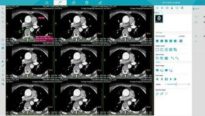Medsinglong bilgisayar tomografisi 32-dilim spektral görüntüleme 2D 3D CT tarayıcı CT makinesi - Product Image 4